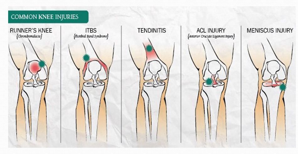 Lutut Bengkak Secara Tiba Tiba  Bagi ligamen yang lebih kuat 
