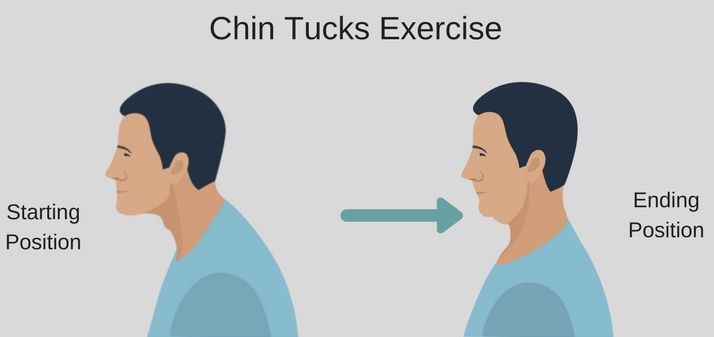 gerakan chin tuck untuk nyeri tengkuk