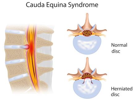 dampak saraf kejepit menyebab sindrom cauda equina