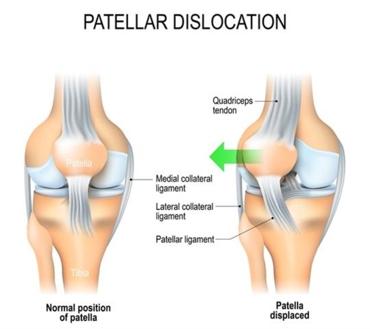 penyebab lutut sakit dislokasi lutut
