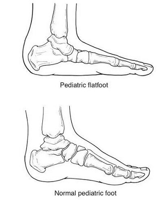 flat foot anak