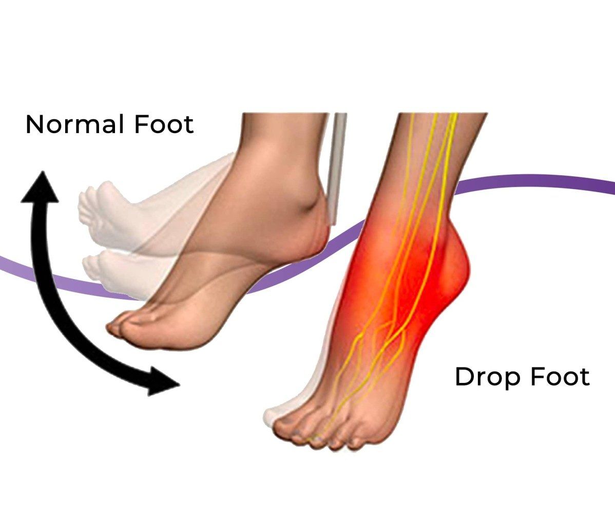 flat foot salah satu penyakit yang membutuhkan alat bantu jalan