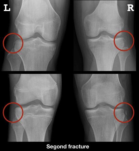 rontgen fraktur segond penyebab nyeri lutut setelah olahraga