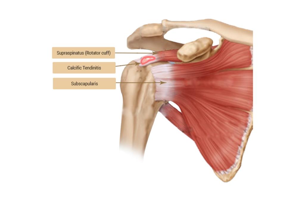 gambaran Tendinopati Kalsifikasi pada Rotator Cuff