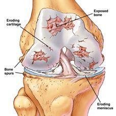 osteoarthritis lutut