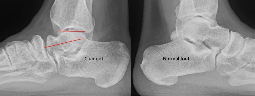 gambaran rontgen untuk deteksi kelainan club foot