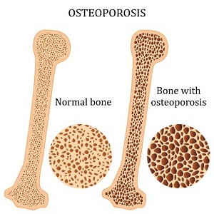 osteoporosis