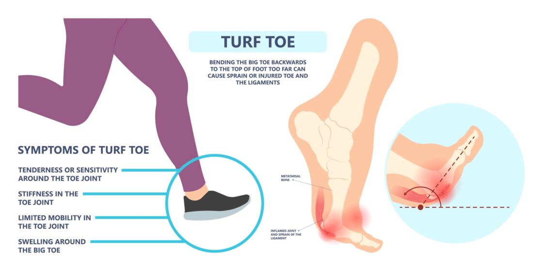 gejala cedera jempol kaki turf toe