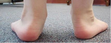 gejala flat foot pada anak