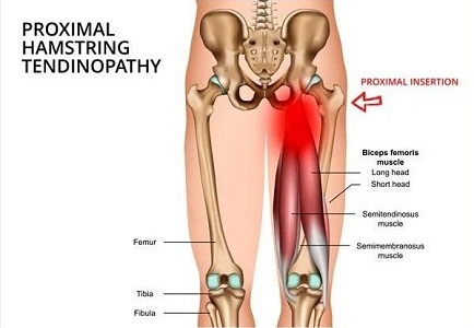 hamstring tendinopati