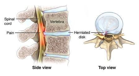 herniasi diskus tulang belakang