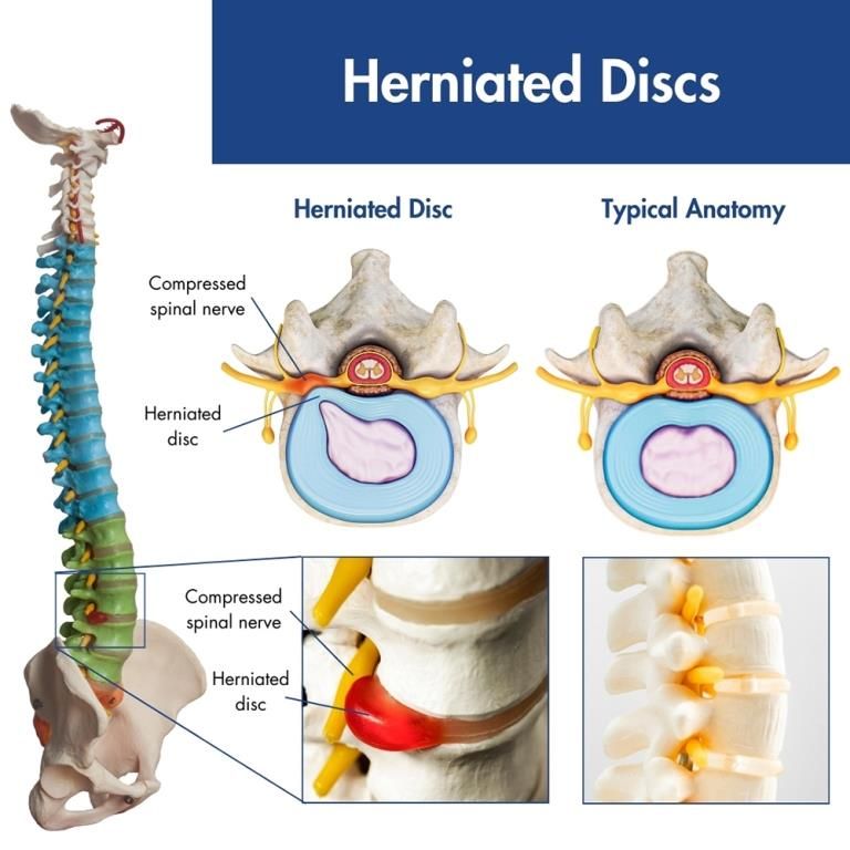 herniasi diskus penyebab nyeri punggung bawah 