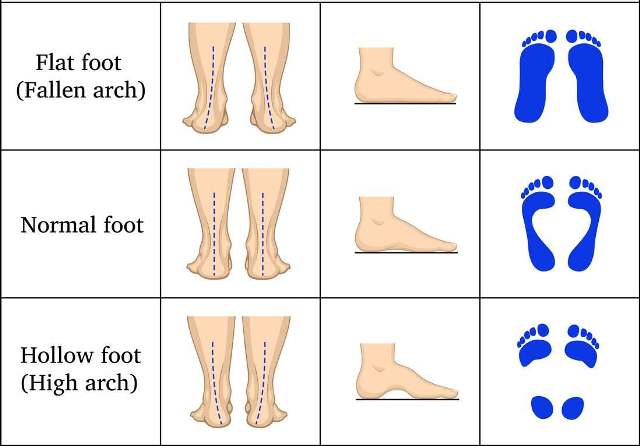jenis-jenis lengkung kaki