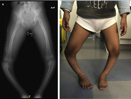 tungkai bengkok atau kaki bengkung