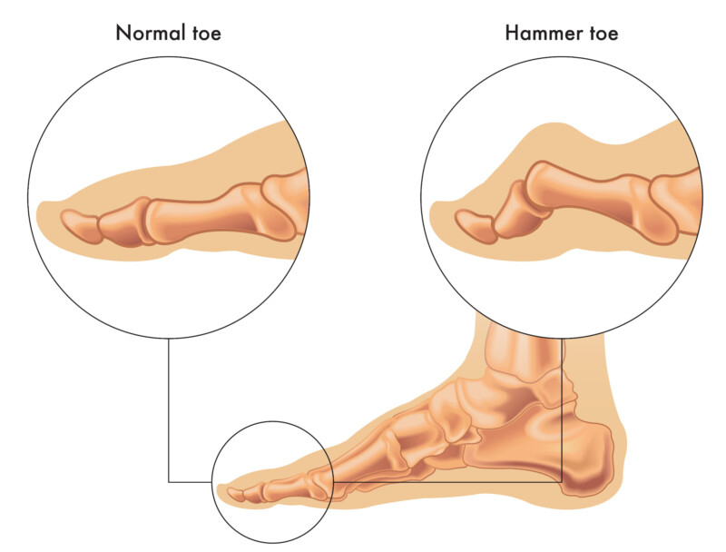 kelainan bentuk jari kaki hammer toe