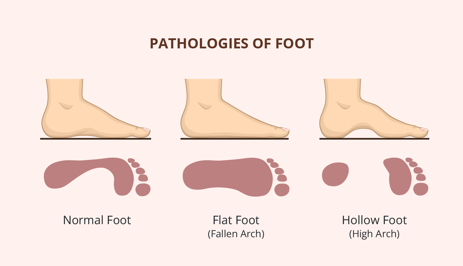 kelainan bentuk kaki yang dapat menyebabkan saraf kejepit pada kaki