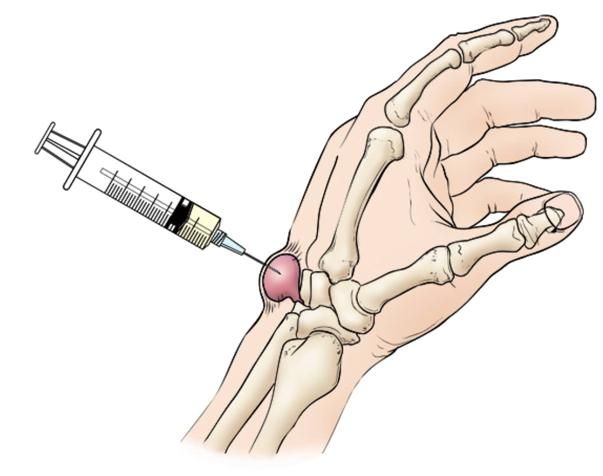 terapi kista ganglion penyebab nyeri punggung tangan