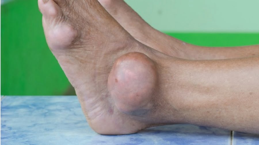 komplikasi asam urat dan rehabilitasi artritis gout