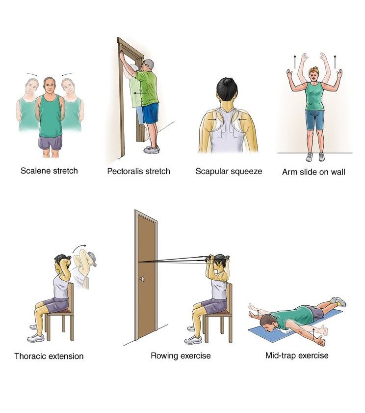 latihan untuk thoracic outlet syndrome