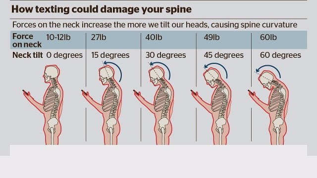 leher sakit akibat texting neck syndrome