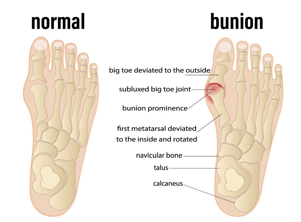 masalah pada kaki bunion