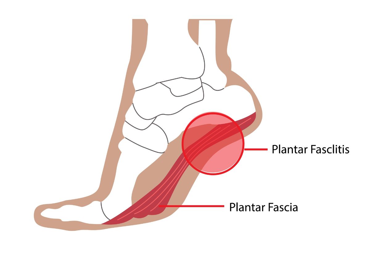 masalah pada kaki plantar fasciitis