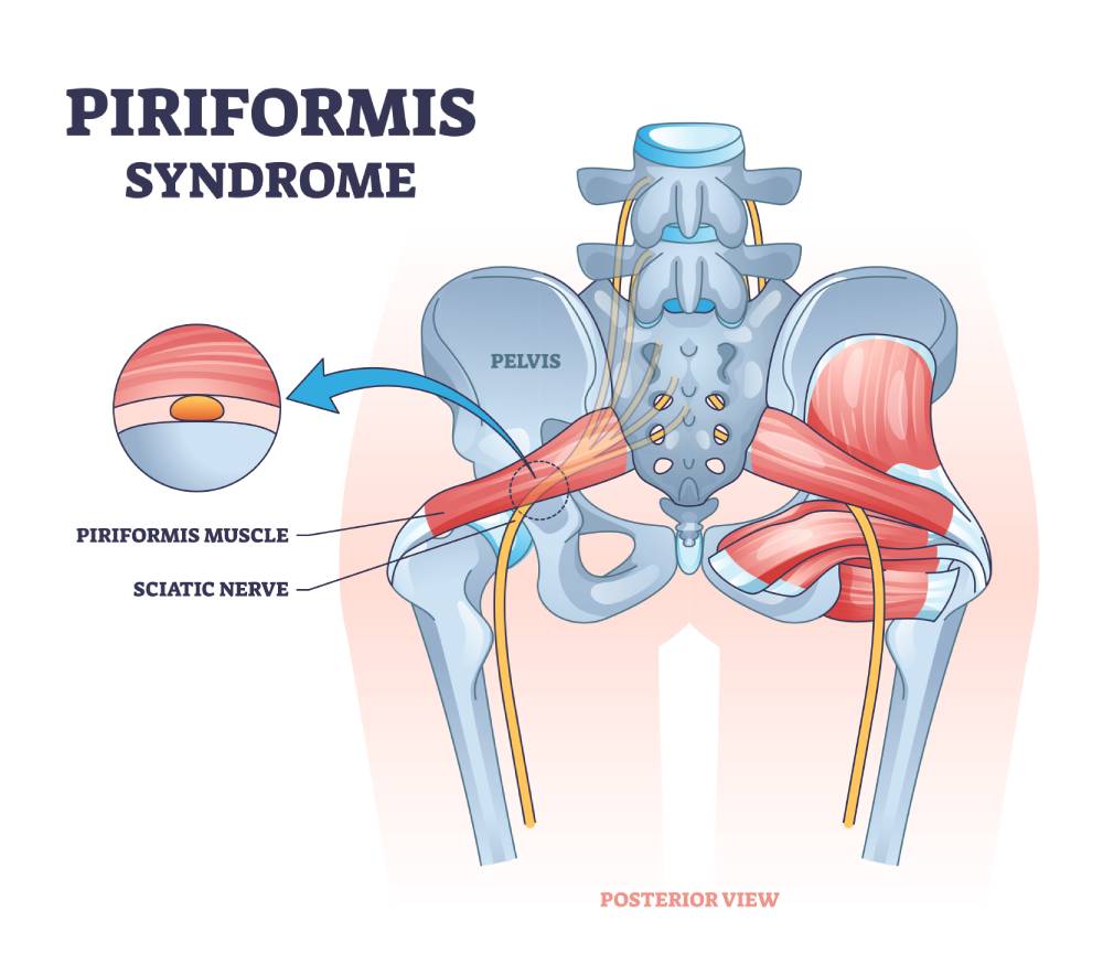 mengenal gejala sindroma piriformis 