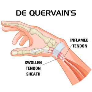 mengenal mommy wrist nyeri pergelangan tangan pada ibu