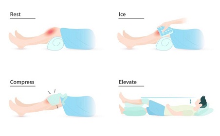 cara mengatasi dengkul bengkak di rumah