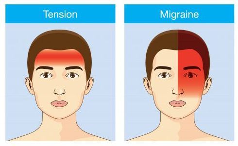 perbedaan sakit kepala migren dan tension