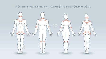 titik nyeri otot fibromyalgia