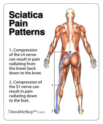 nyeri punggung bawah akibat sciatica