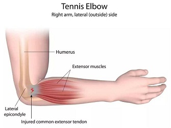 nyeri siku karena tennis elbow