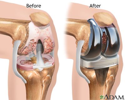 operasi penggantian lutut total