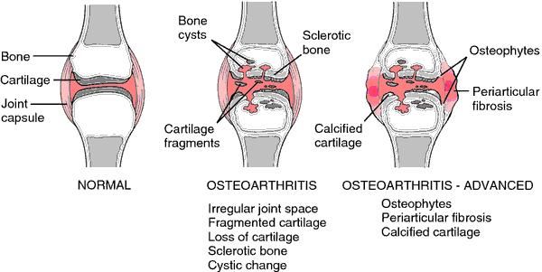 osteoarthritis pengapuran sendi