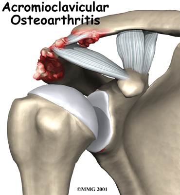 osteoarthritis bahu
