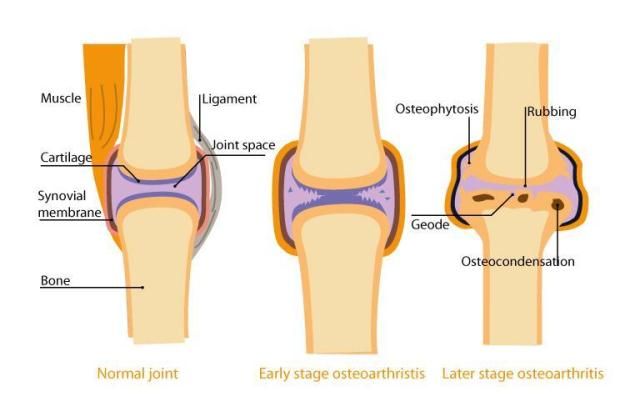 osteoarthritis lutut radang sendi