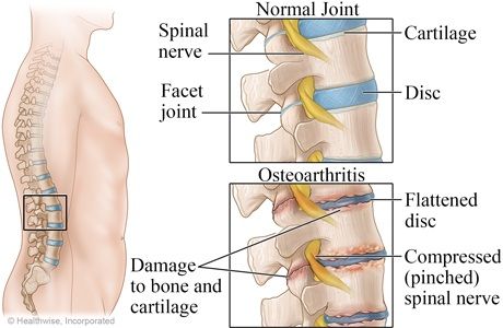 pengapuran tulang belakang osteoarthritis