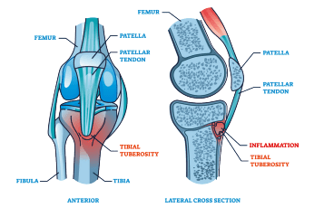 penyakit osgood-schlatter