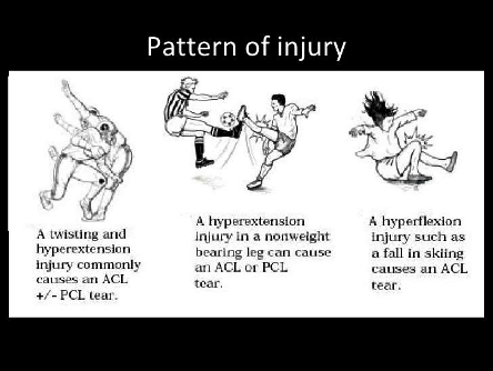 cedera ACL lutut