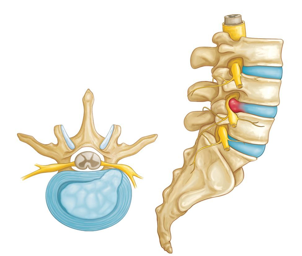 penyebab hernia nukleus pulposus