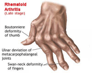 penyebab jari bengkok akibat rheumatoid arthritis