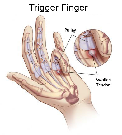 penyebab jari kaku tersering akibat trigger finger