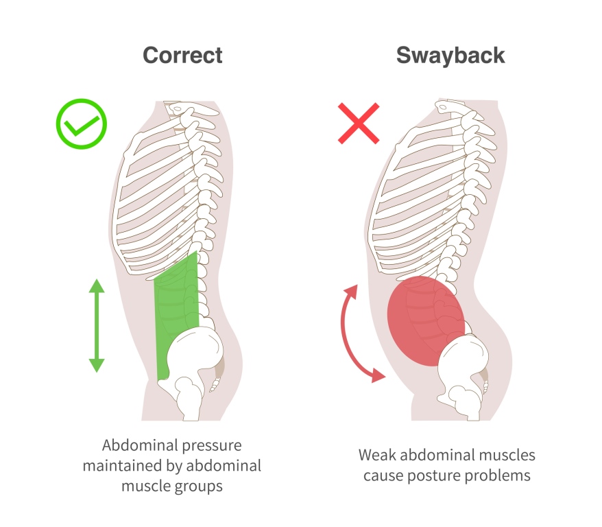 penyebab kelainan tulang belakang lordosis