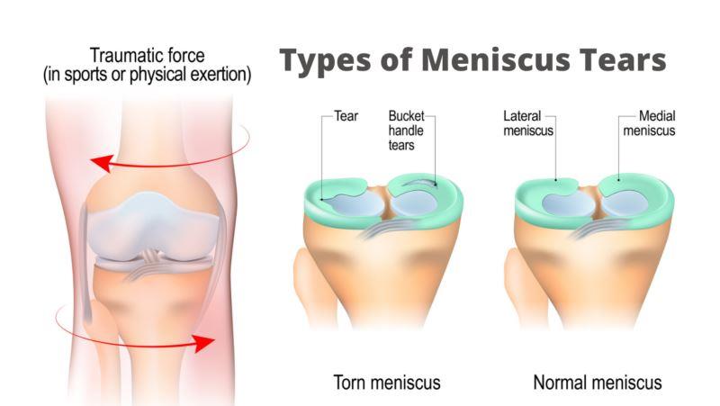 penyebab nyeri belakang lutut nyeri meniscus tear