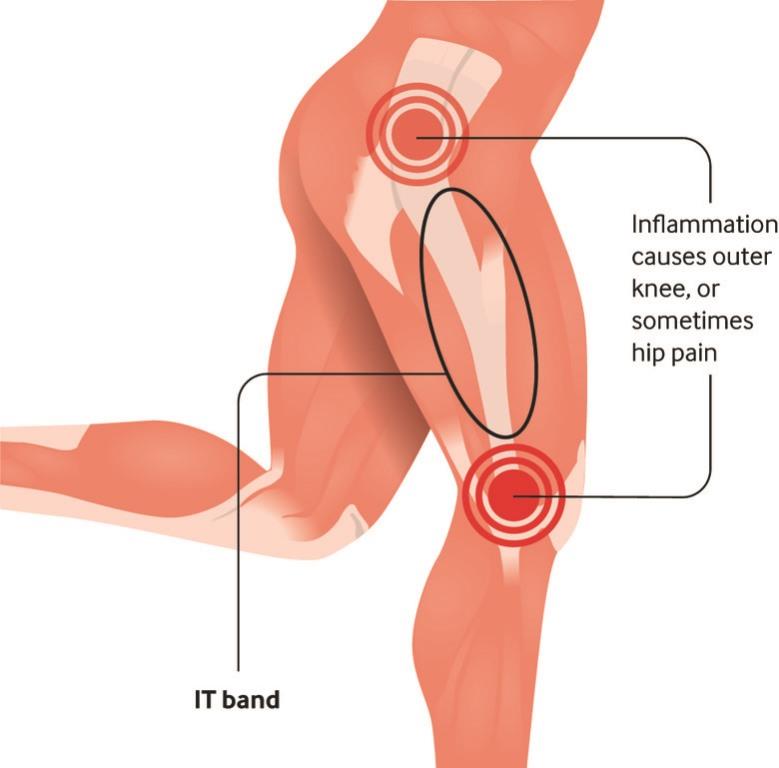 penyebab sakit lutut sebelah luar akibat iliotibial band syndrome