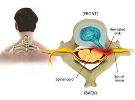 herniasi diskus leher