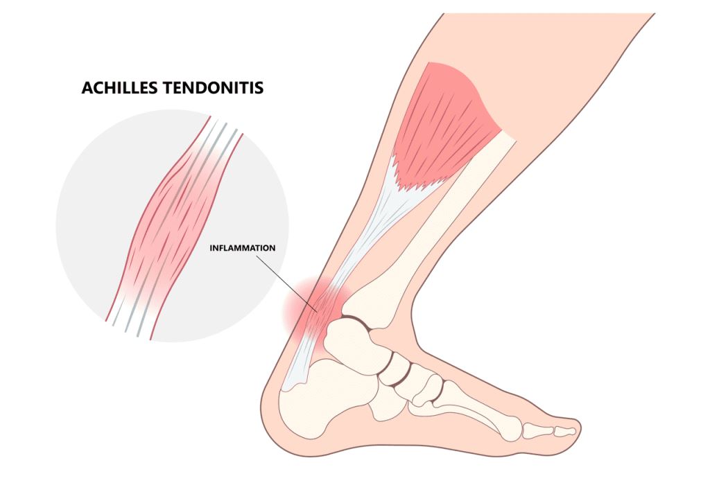 penyebab tumit sakit tendinitis achilles