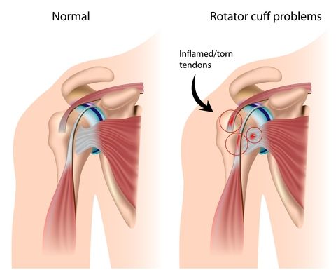 peradangan tendon penyebab sering sakit bahu