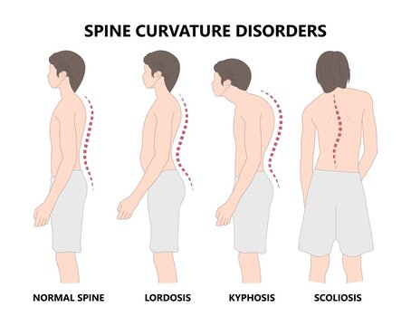 perbedaan kelainan tulang belakang lordosis , kifosis , dan skoliosis 